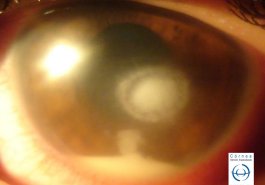 Úlcera corneal con hipopion