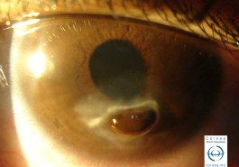 Perforación corneal - Herpes simple