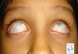 Esclerocornea bilateral