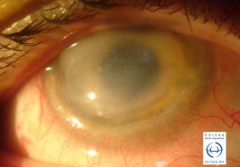 Melting corneal en paciente con artritis reumatoide