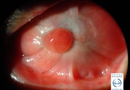 Quemadura ocular anquiloblefaron y granuloma piogeno